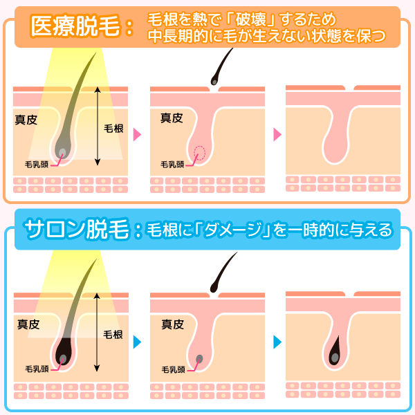 医療脱毛とサロン脱毛の毛が抜ける仕組みの図解