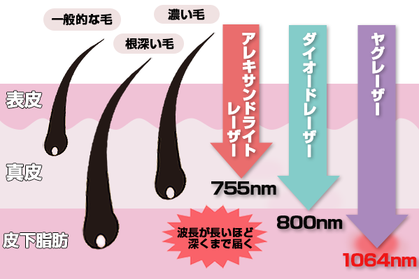 医療脱毛のレーザーの種類