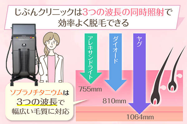 じぶんクリニックは3つの波長で幅広い毛質に対応