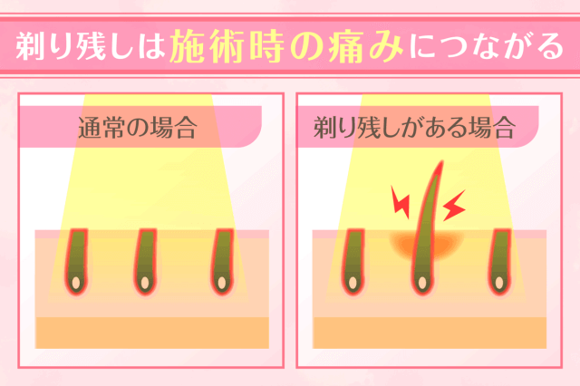 医療脱毛は剃り残しが痛みにつながる場合がある