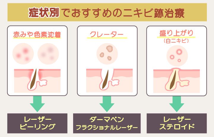 ニキビ跡の特徴別におすすめのニキビ跡治療を示す画像