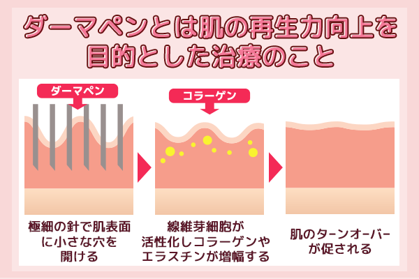 ダーマペンとは肌の再生力向上を目的とした治療のこと
