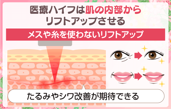 医療ハイフ(HIFU)って何?超音波を肌に照射する切らないリフトアップ施術