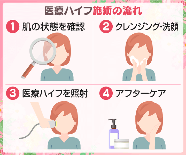 医療ハイフ(HIFU)の施術の主な流れ