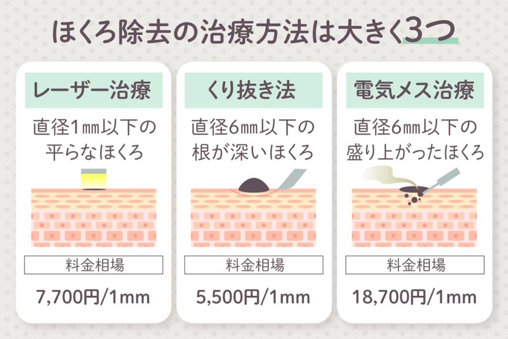 ほくろ除去の治療方法は大きく3つの種類がある