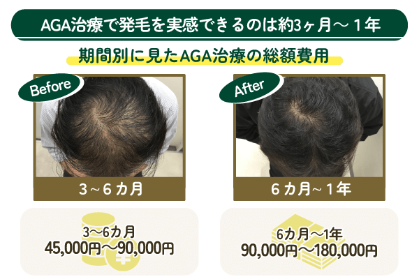 AGA治療にかかる期間と費用総額を示す画像