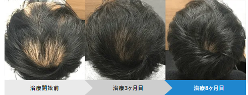 AGAへアクリニックの発毛プランの症例画像