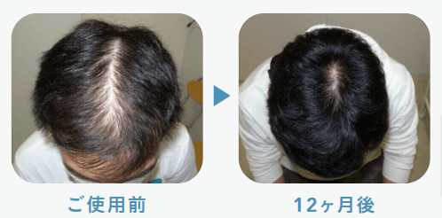 ウープスでAGA治療を行った人の症例画像