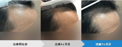 AGAへアクリニックの効果的な発毛プランの症例画像