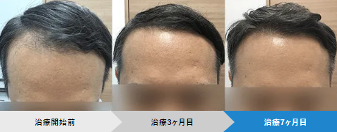 AGAへアクリニックの発毛プラン前頭部症例画像