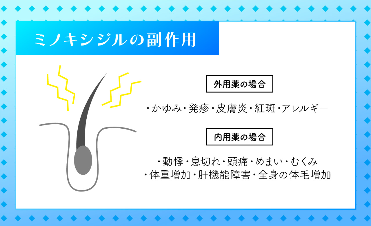 ミノキシジルの副作用外用と内服。やめてよかったという人もいるの画像