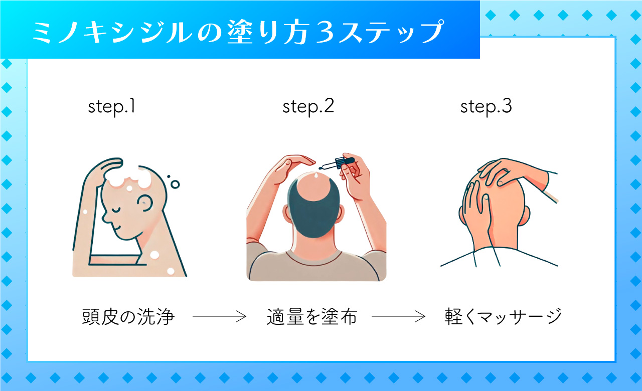 ミノキシジル濃度を5パーセント以上が国内の最大濃度画像