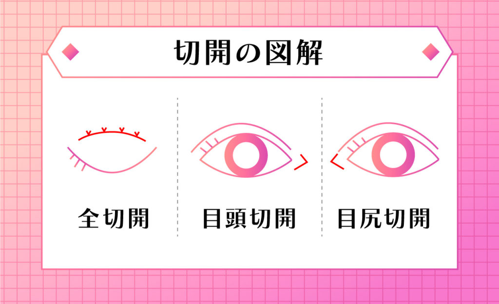 全切開とミニ切開図解