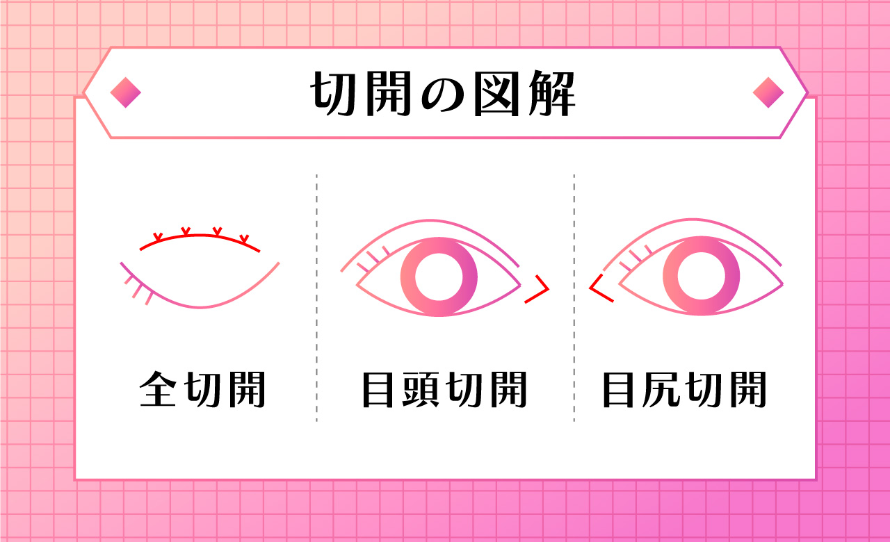 全切開とミニ切開図解