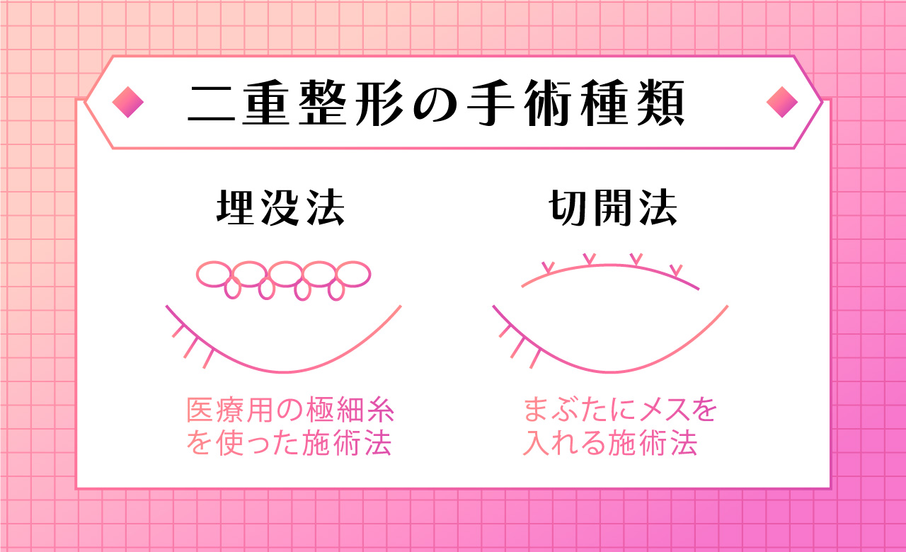 二重切開法埋没法図解