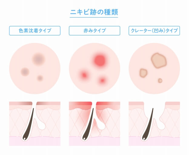 ニキビ跡の種類と原因