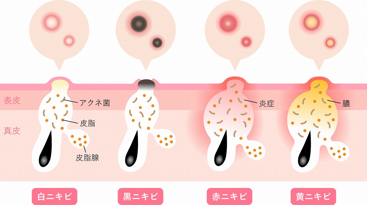 ニキビの種類と症状・対処法