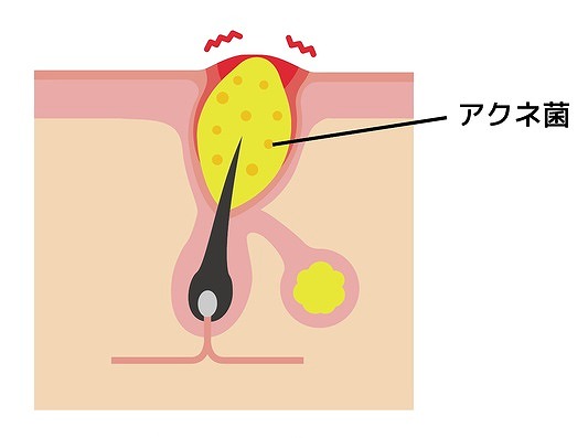 赤ニキビ