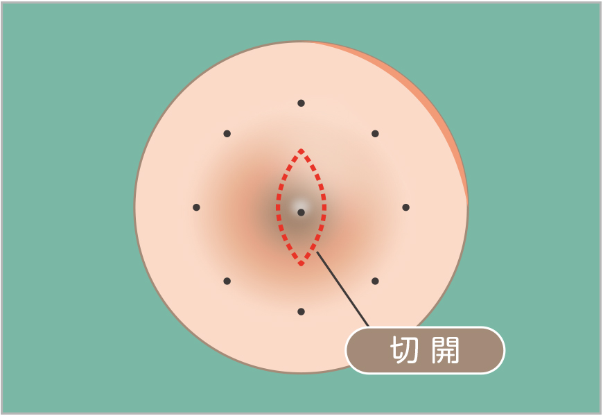 粉瘤の単純切開1