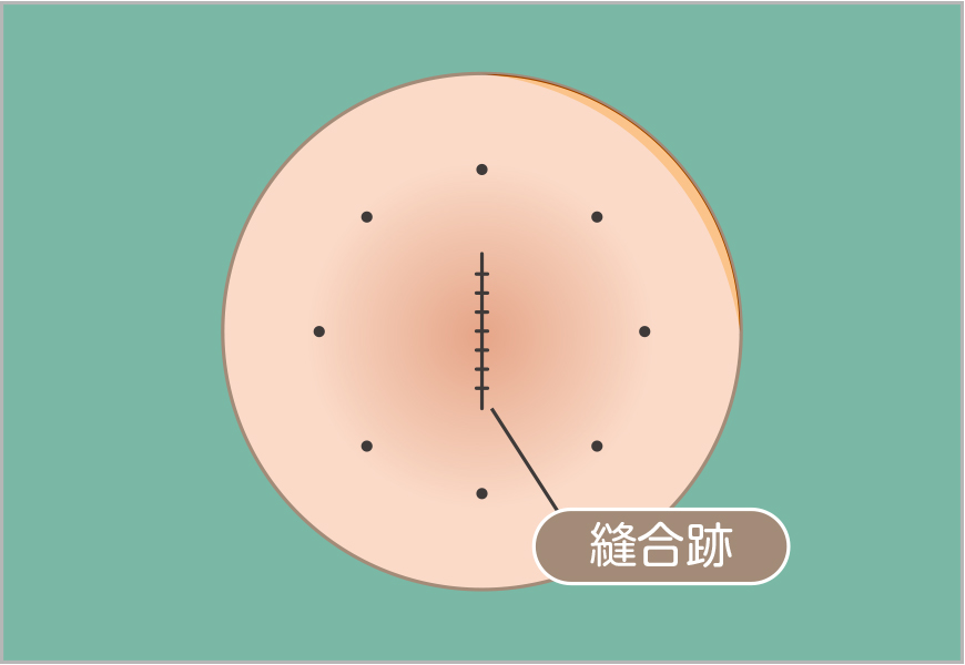 粉瘤の単純切除2