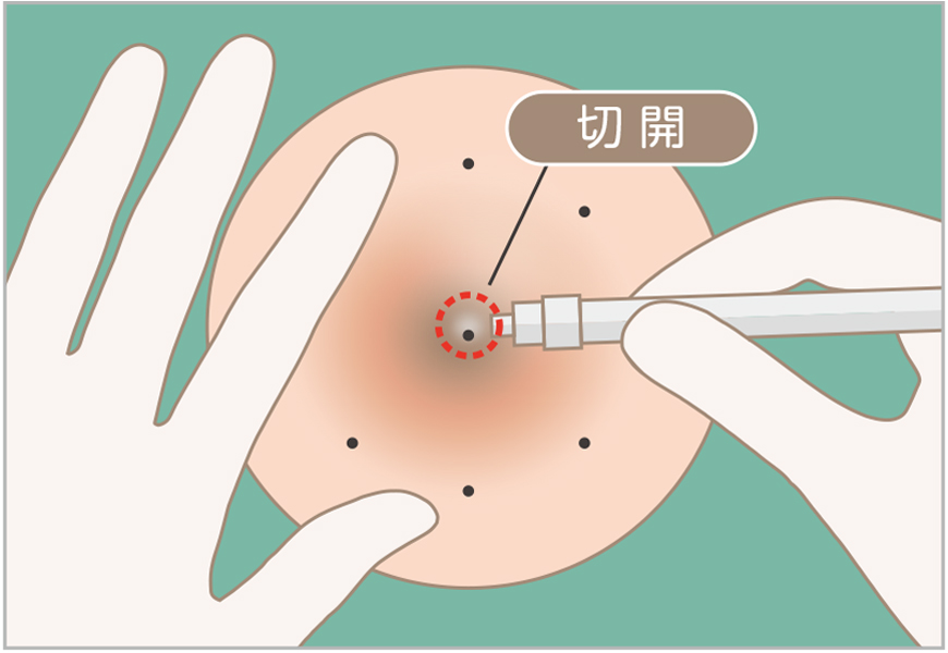 粉瘤のくりぬき法1