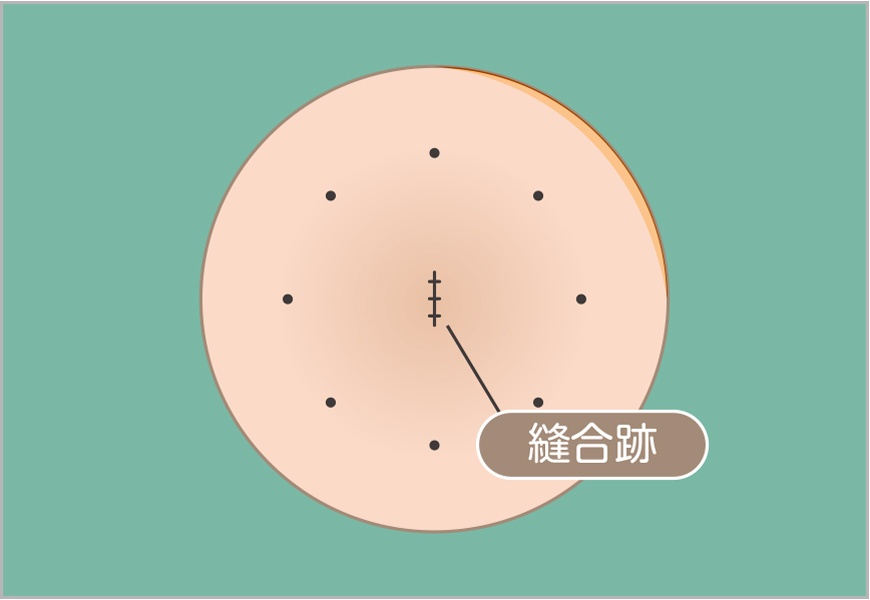 粉瘤のくりぬき法2