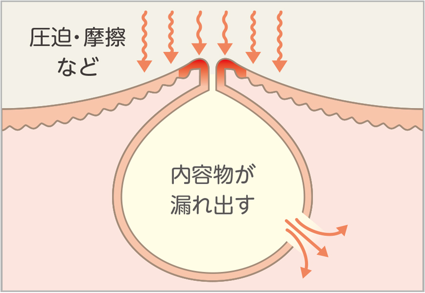 炎症性粉瘤