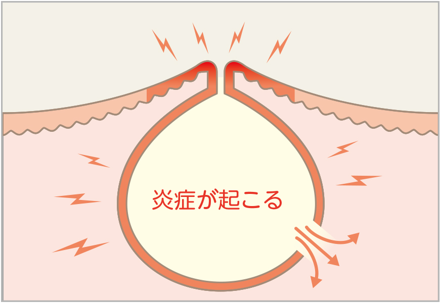 炎症性粉瘤2