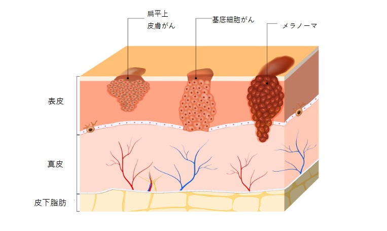 皮膚がん