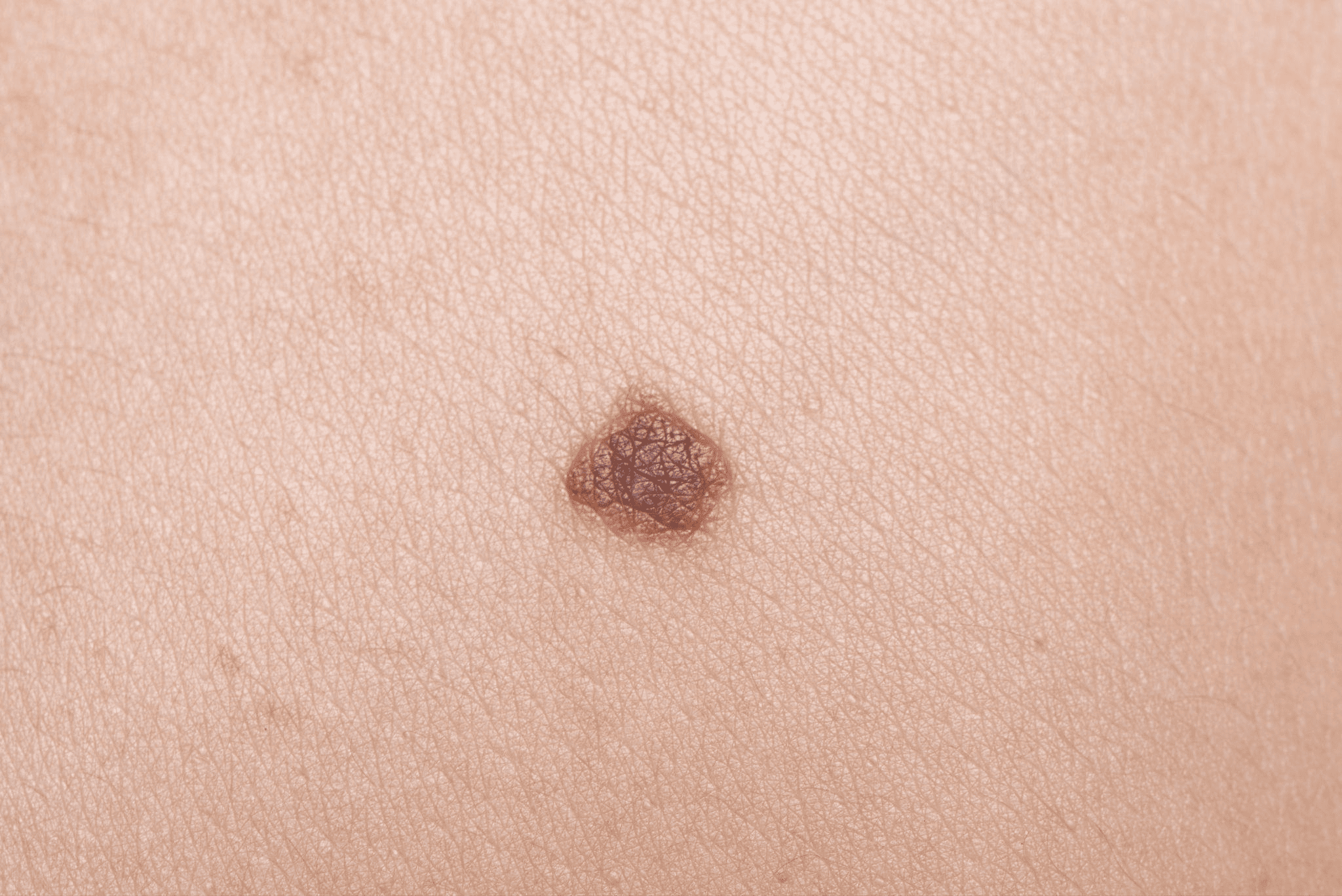 イボとホクロの違いは？原因・種類・治療方法について解説