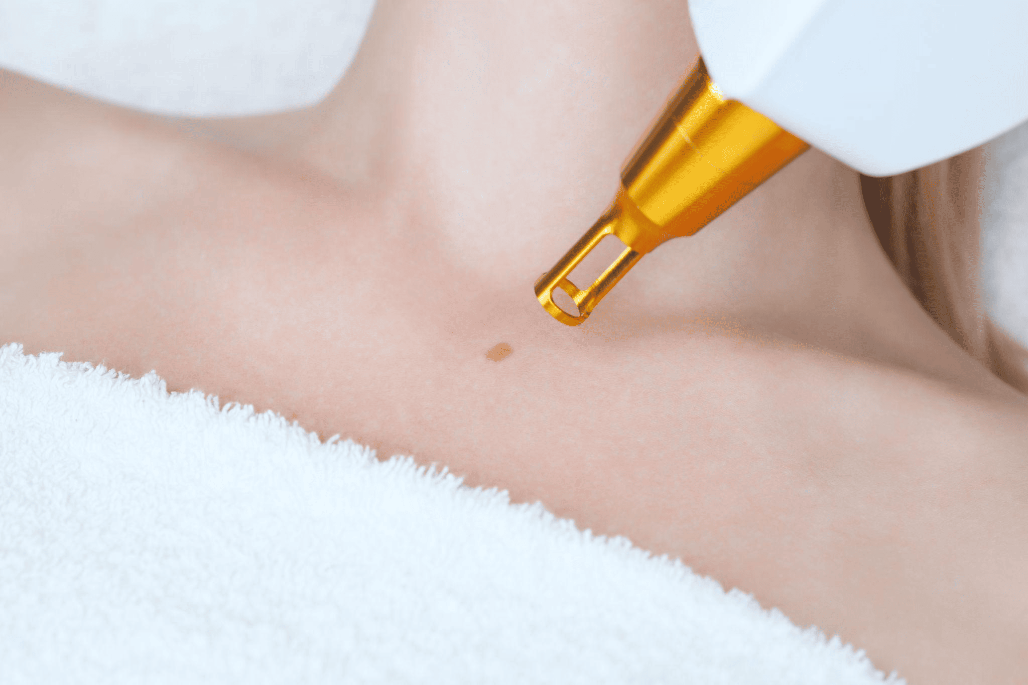 ホクロの治療方法