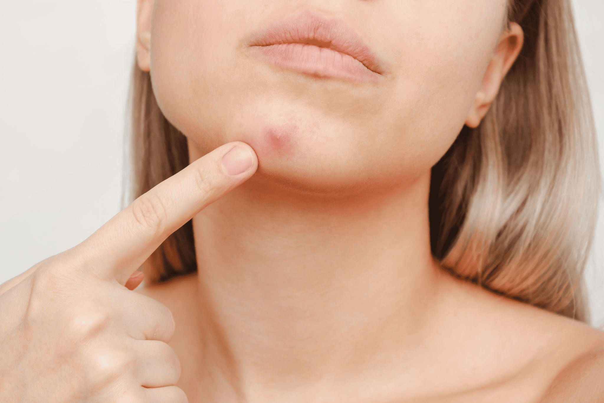 ニキビと吹き出物の違い