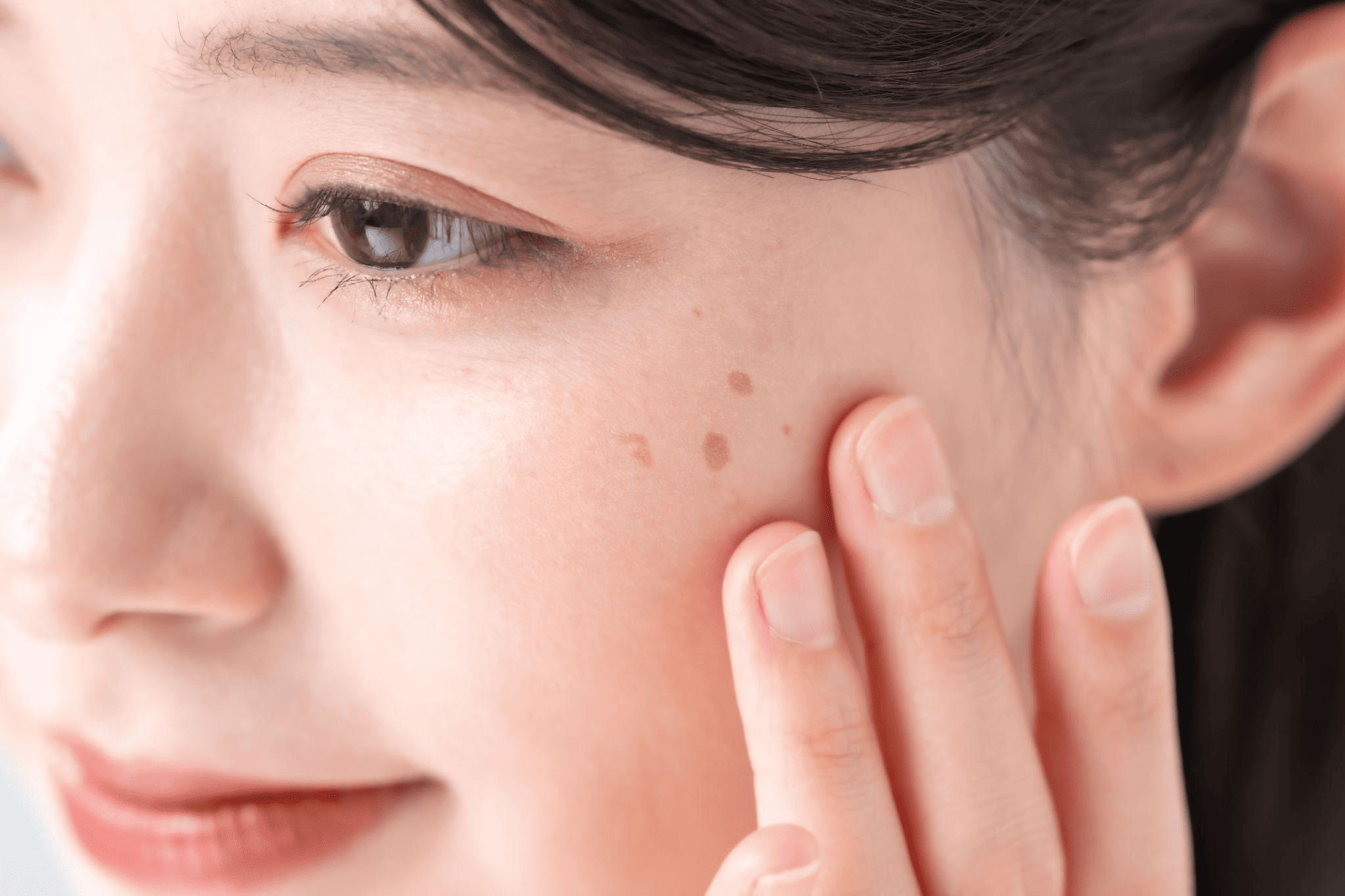 ニキビ跡の主な種類